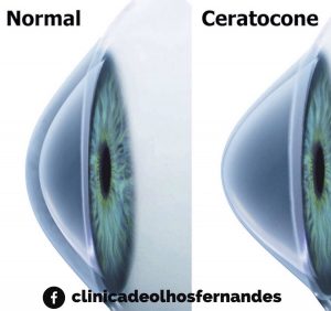 Córnea Normal versus com Ceratocone