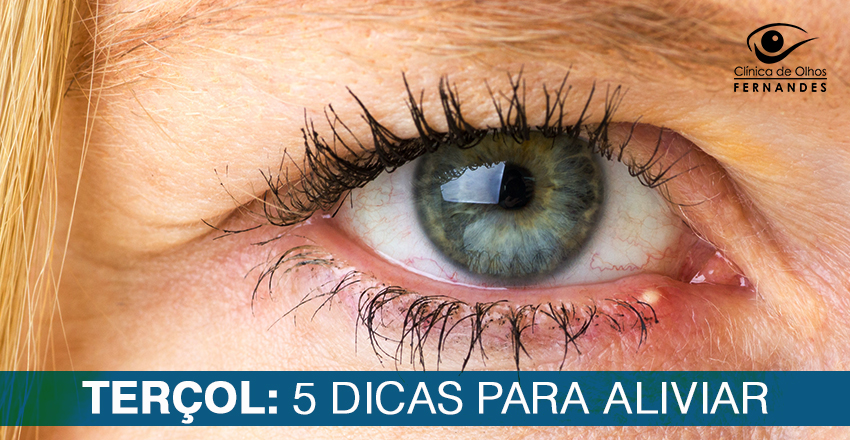 Terçol: 5 Dicas para Aliviar - Clínica de Olhos Fernandes