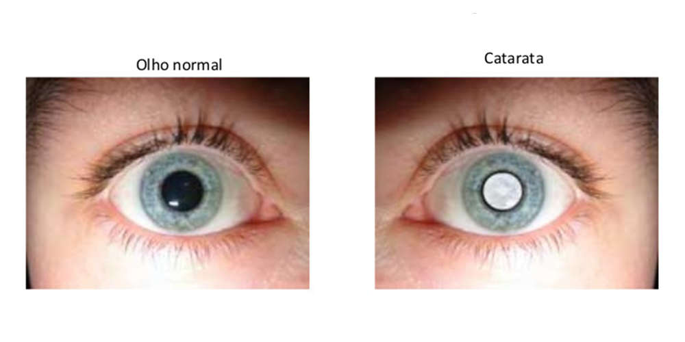 Olho Normal x Olho com Catarata