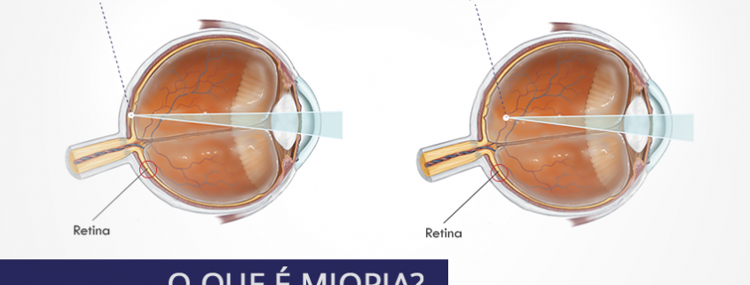 O que é Miopia? - Comparação Olho sem miopia e olho com miopia