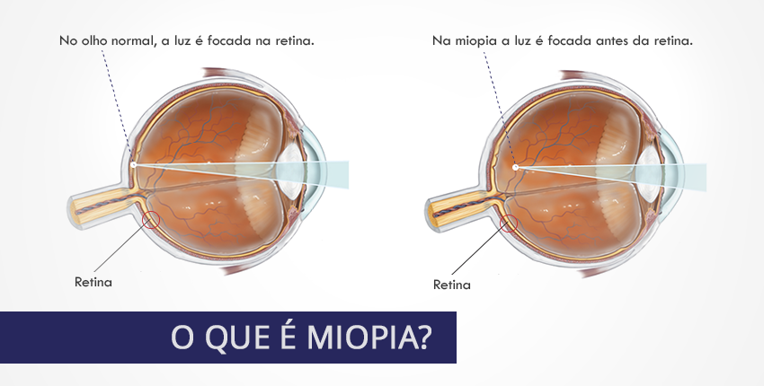 O que é Miopia? - Comparação Olho sem miopia e olho com miopia
